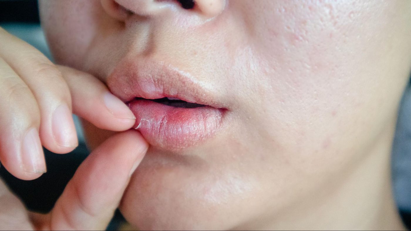 เปรียบเทียบปากแห้งในช่องปากกับริมฝีปากแห้งลอก